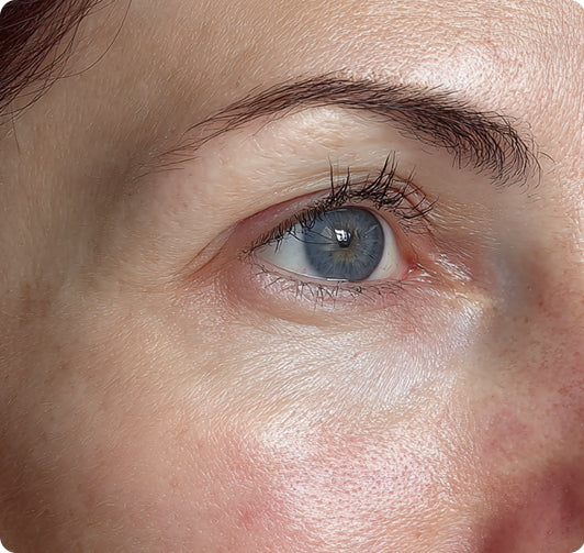 dark eye circles image